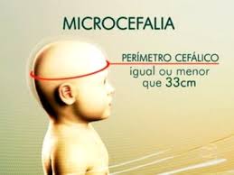 Ministério da Saúde confirma primeira suspeita de microcefalia relacionada ao zika vírus no RS