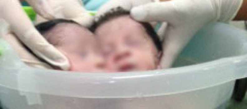 Hospital Tramandaí realiza primeiro banho de balde de ofurô em bebês gêmeos no Centro Obstétrico