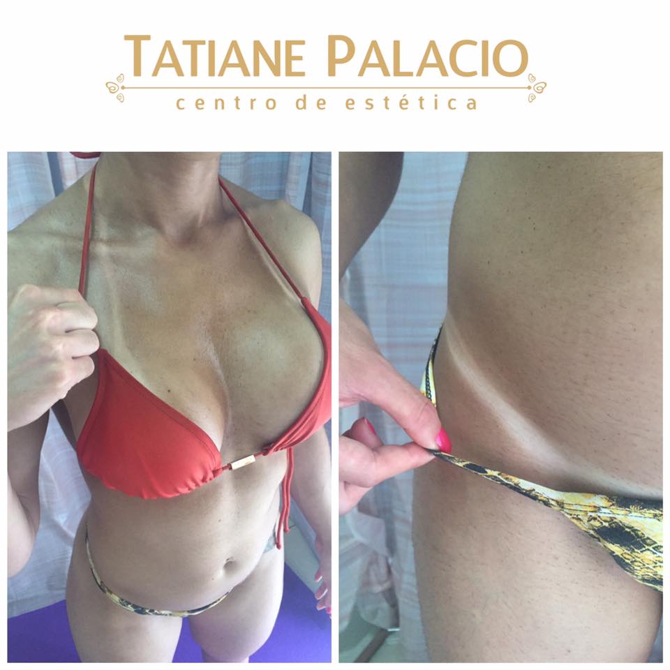 Estética Tatiane Palacio: semana com 50% de desconto na Criolipólise e aplicações de Jet Bronze Key por apenas R$ 100,00