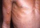Segue subindo casos de varíola dos macacos: veja sintomas