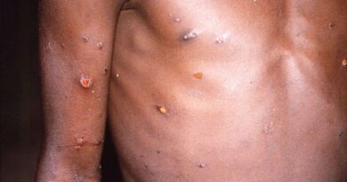 Saúde do RS confirma transmissão comunitária da monkeypox