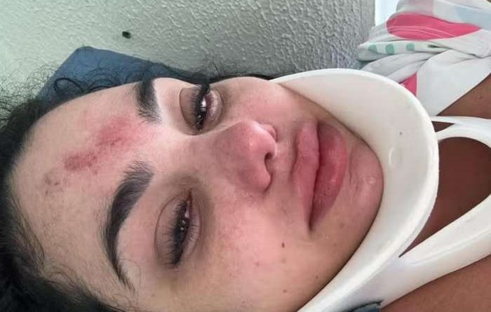 Acidente em piscina: mulher sofre fratura cervical em Capão da Canoa